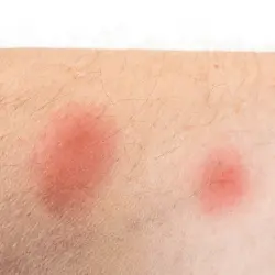 Imagen de picadura de chinches