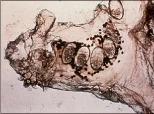 Acaro de la Sarna Sarcoptes Scabiei